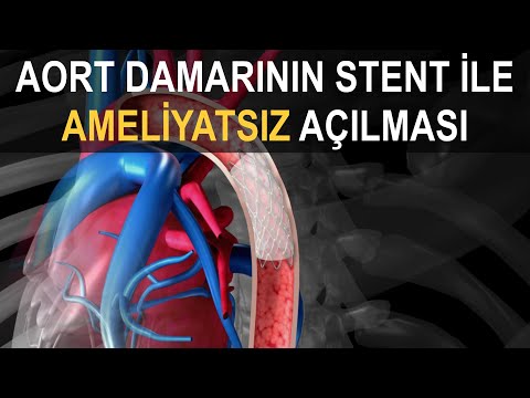 Aort Koarktasyonunun Stent ile Tedavisi