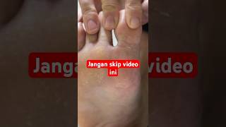 Kaki Rayapan Sembuh Dengan Cara Ini Harus Nonton