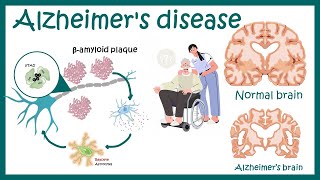 Alzheimer's disease - plaques, tangles, causes, symptoms, pathology and current research