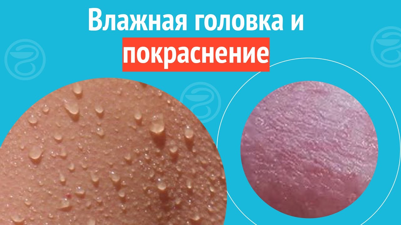 😠 Влажная головка и покраснение. Клинический случай №1166