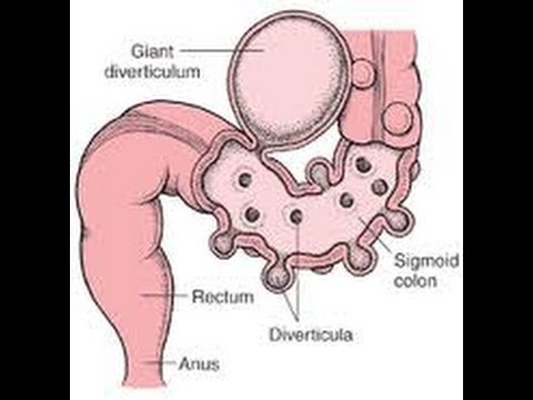 ডাইভার্টিকুলাইটিস আক্রমণ প্রতিরোধের শীর্ষ 3 উপায়