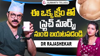 Dr Rajasekhar About Stretch Marks Removal Cream | Sriroop Cosmetic Clinic | @sumantvtelugulive