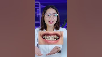 Phẫu thuật hàm móm sau niềng răng | Lạc Việt Intech Niềng Răng #shorts