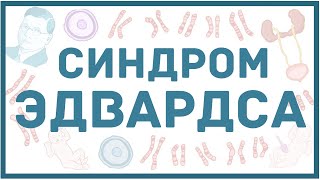 Синдром Эдвардса - механизм развития, причины, клинические проявления