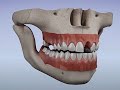 Acrylic Partial Denture Flipper