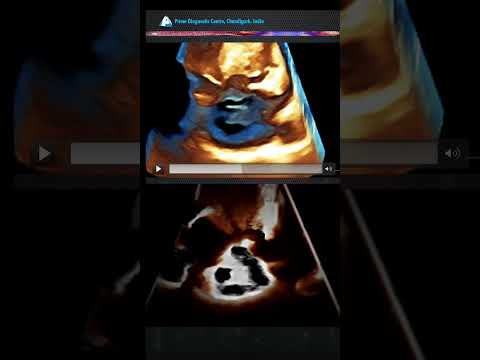 Multiple Holes in the Heart?! Rare type Fenestrated ASD 🫀