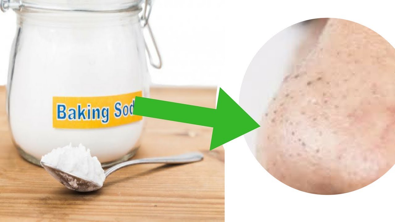 12 DIY Baking Soda Remedies for Blackheads - YouTube