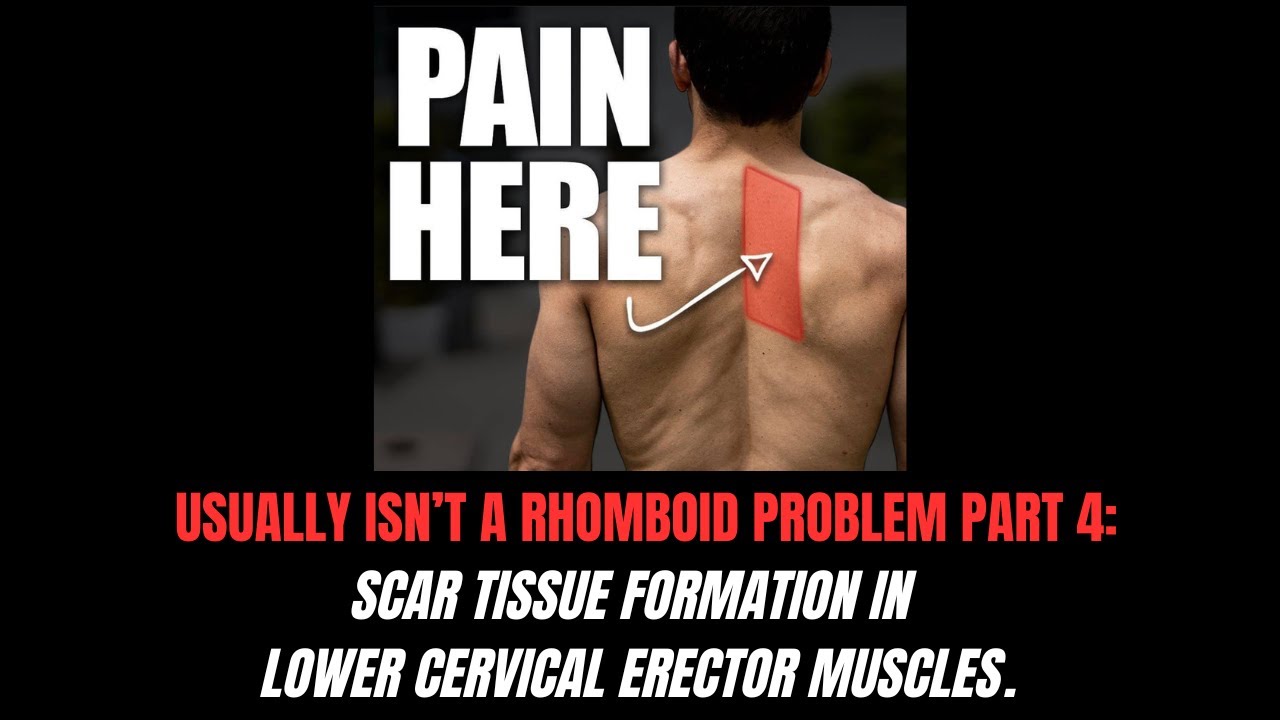 Mid Back Pain Usually Isn’t A Rhomboid Problem: Scar Tissue Formation In Lower Cervical Erectors.