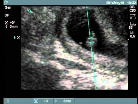 Ecografia 8 Semanas Y 2 Dias De Embarazo Youtube