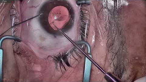 ICLs explantation in different stages
