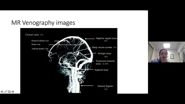 Webinar - CVST Cerebral Venous Sinus Thrombosis wi...