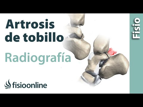 Vídeo: Artrosis De Tobillo