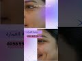 زيدي جمالك جمال مع غمازة الخد ل أكثر و إبتسامة جذابة ومشرقة 00899951153 غمازة عمليات تجميل