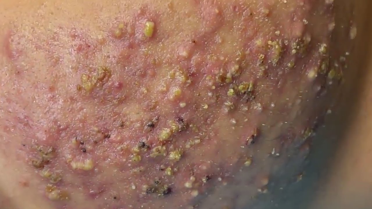 Cystic Acne Explosion