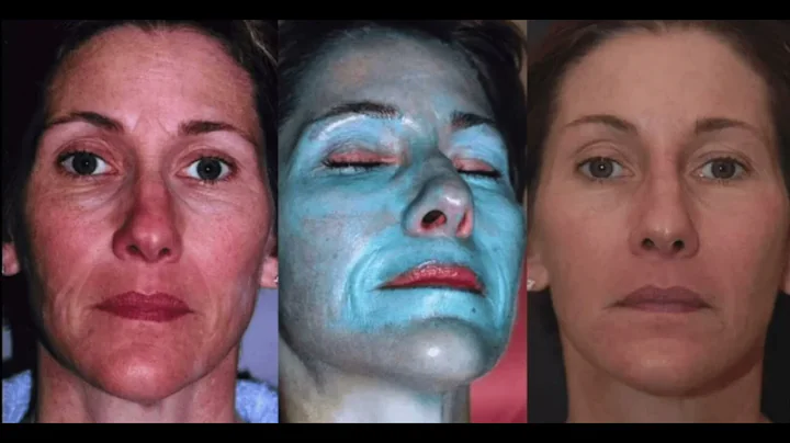 Lauri Kane Explains All about TCA Peels and their Incredible Results