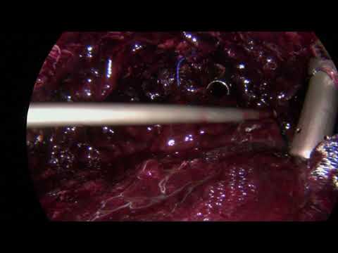Video: Anses ett subkorioniskt hematom vara högrisk?
