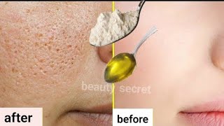 In just two days, all the enlarged pores on your skin will disappear/narrow the enlarged pores.