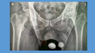 Computer Guided Total Hip Replacement