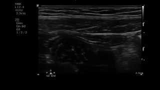 Pedabd - Appy 5 - Hfp 6 Yo Normal Appy Non Tender