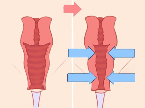 Video: Vaginoplastik: Risiko Og Bedring Af Kønskontrol Af Kirurgi