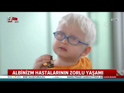 Albino Hastlarınının Zorlu Yaşamı! (A Haber)/ Haber Ekranı