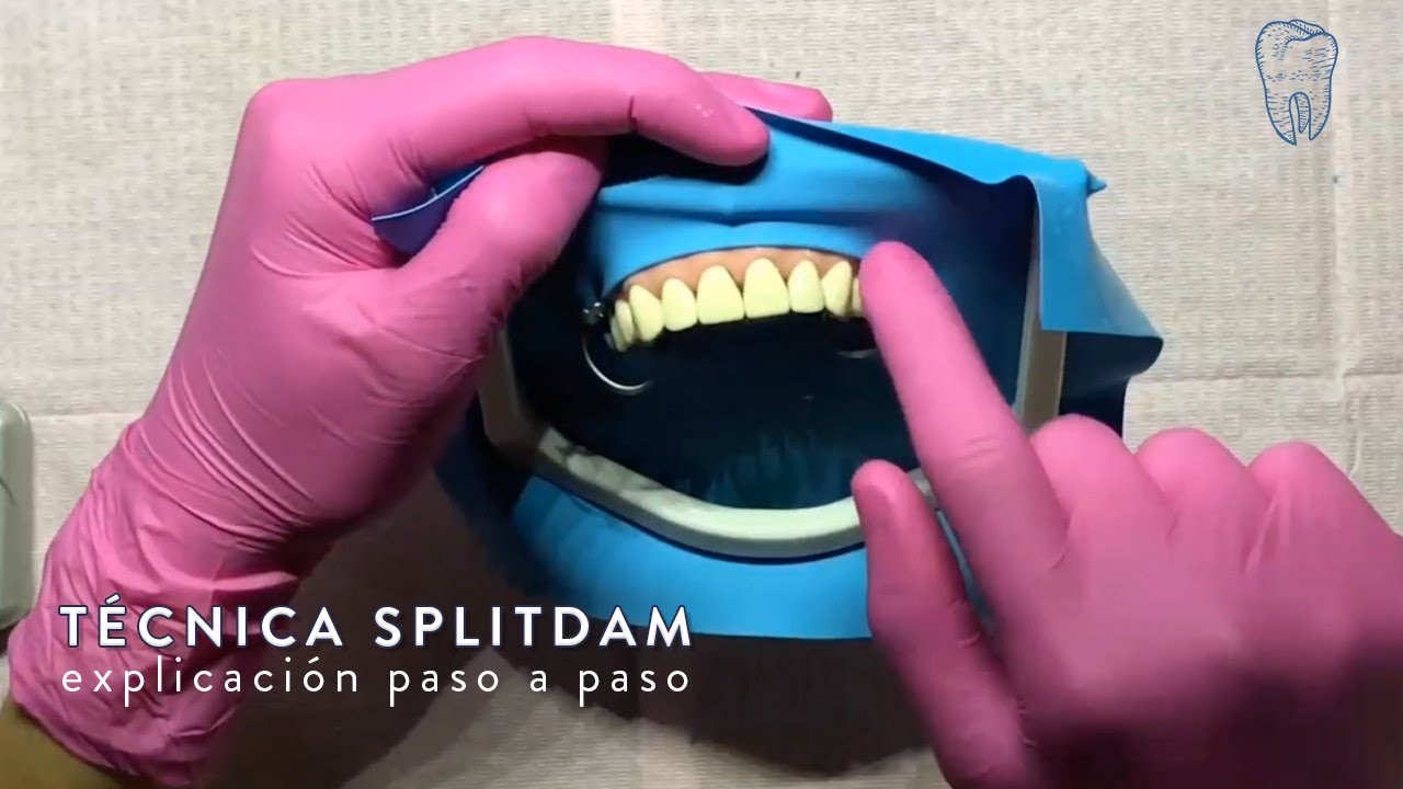 Aislamiento Absoluto: Técnica SplitDam