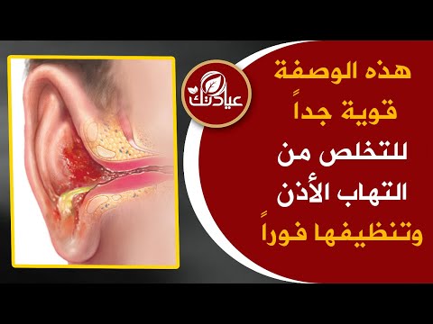 فيديو: علاج التهاب الأذن الوسطى بالعلاجات الشعبية