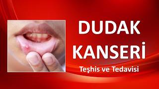 DUDAK KANSERİ Teşhis ve Tedavisi