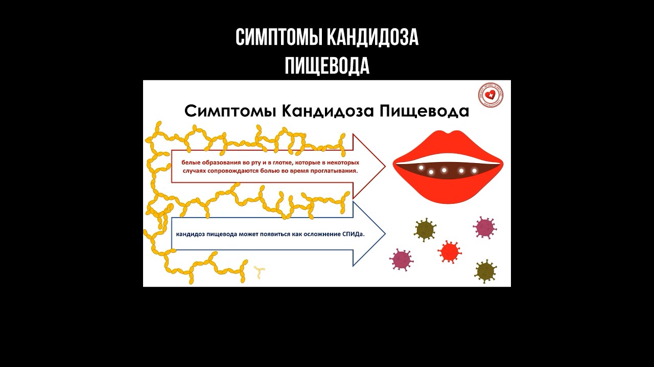 Симптомы кандидоза пищевода #кандидоз #пищевод #кандидозпищевода #миколог