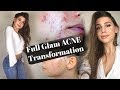 MY ACNE COVERAGE FULL GLAM NIGHT OUT MAKEUP TRANSFORMATION & HAIR ROUTINE Ft Duvolle Hair Products!