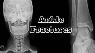 XR I Ankle Fractures