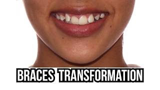 Braces Before & After: Impacted Canines, Extractions (30 Months)