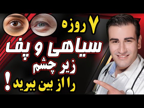 تصویری: 3 راه برای از بین بردن سیاهی چشم