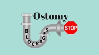 Dealing With Ostomy Blockages: Ostomy Tips