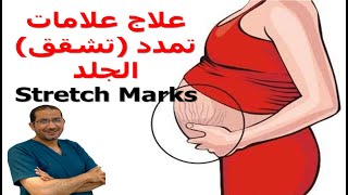 علامات تمدد تشقق الجلد Stretch Mark الأسباب والأعراض وكيف تتجنبها وكيف تعالجها   #د_سامح البكري