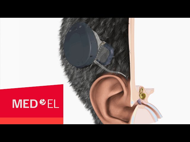 The RONDO cochlear implant from MED-EL | 2D | INT class=