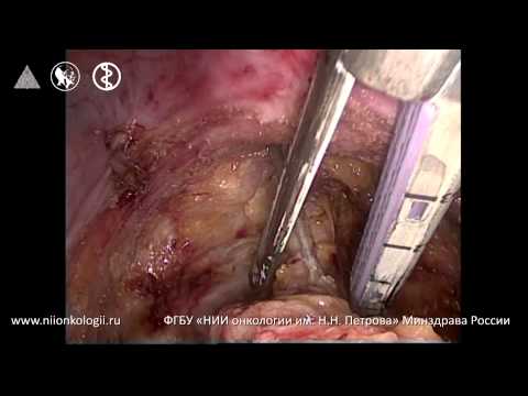 Laparoscopic TME For Femail Middle Rectal Cancer CT2N0M0