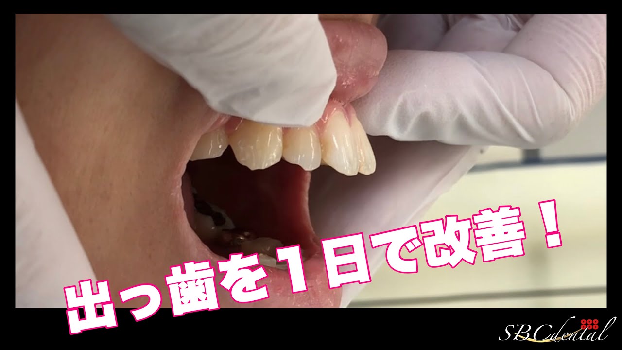 １日で出っ歯を治す方法がコレ Youtube
