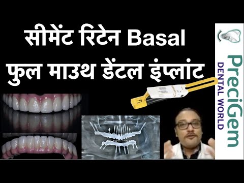 Basal implant in Mumbai l Cement retained Full Mouth Dental implants - Dr Mayur Khairnar | India