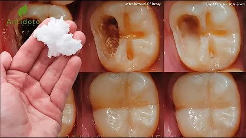 ¿Pronamel fortalece los dientes?