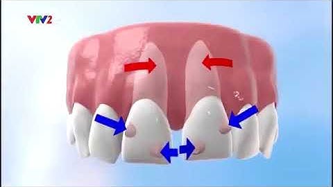 Niềng răng invisalign - giải pháp chỉnh nha hoàn hảo nhất hiện nay - Athena