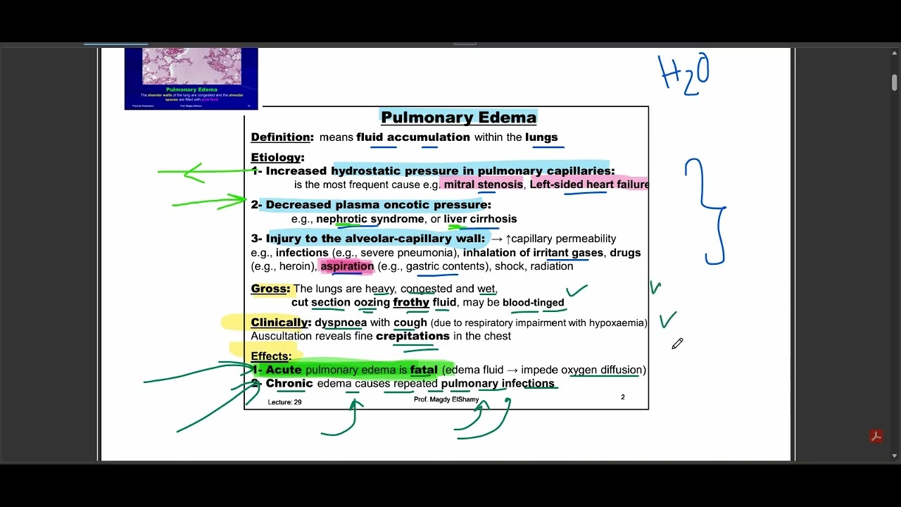 pulmonary edema - tabuk university - review lecture
