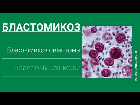 Видео: бластомикоза