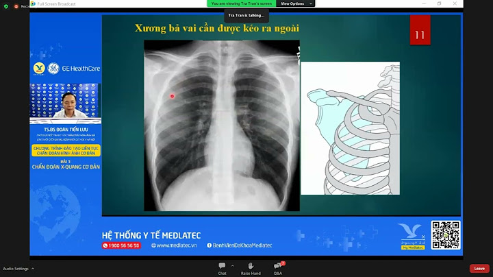 Hướng dẫn đọc x quang lao phổi năm 2024