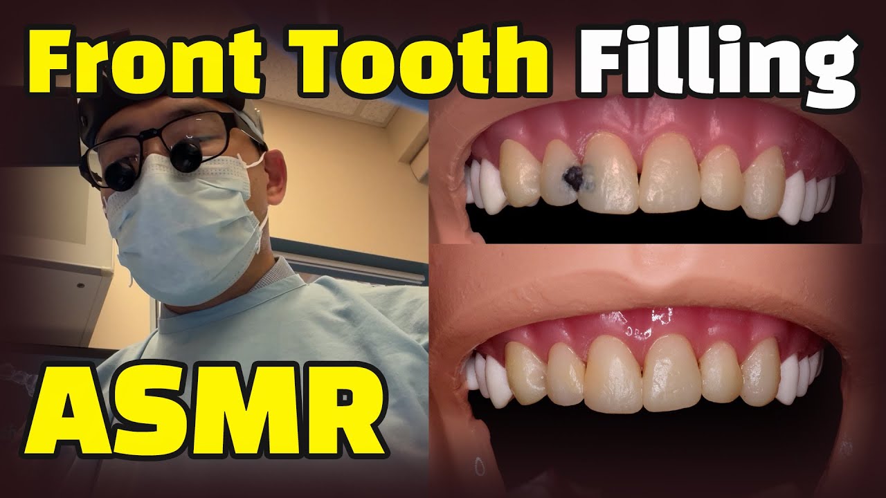 How To Fix Cavities Between Front Teeth + Dental Asmr (Composite Resin Filling Procedure Explained)