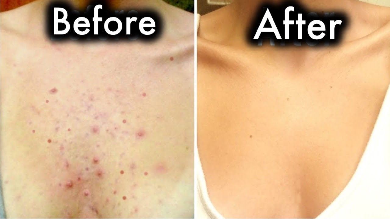 Get Rid Of Chest Acne In Few Days With These Home Remedies Youtube