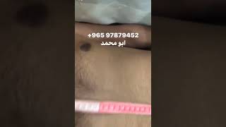 علاج الابهر وتعديل صدر المريض - ابو محمد الكويت