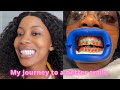 My Journey To A Better Smile : Bleaching Teeth