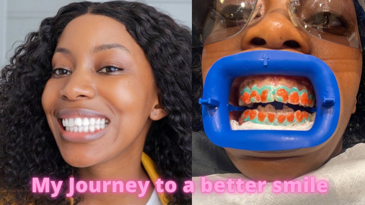 My Journey To A Better Smile Bleaching Teeth YouTube
