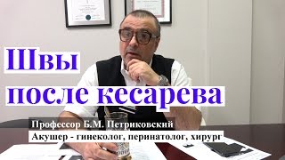 Швы после кесарева сечения - интервью с профессором Петриковским о родах в США